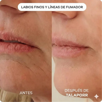 El sistema de microinfusión™