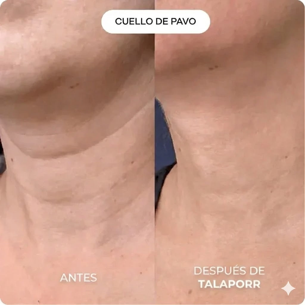 El sistema de microinfusión™