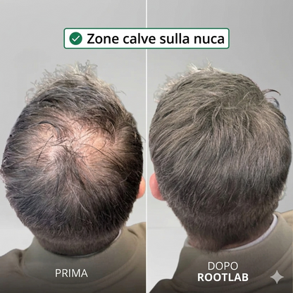 Sistema de crecimiento capilar Apex