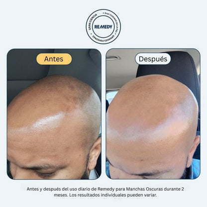 REMEDY para manchas oscuras | Tratamiento todo en uno para corregir manchas oscuras