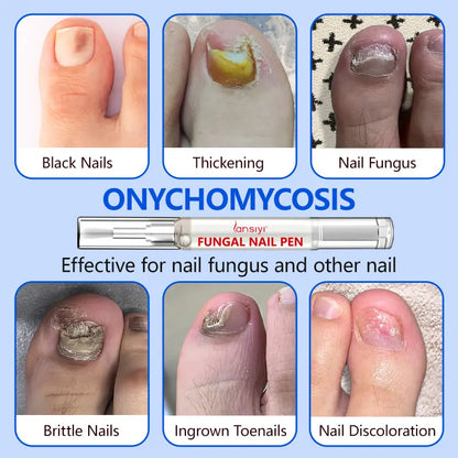 Lápiz para hongos en las uñas Lansiyi con alicina y ácido undecilénico, lápiz para el cuidado de las uñas, lápiz para el tratamiento de hongos en las uñas y otros problemas de uñas, kit de cuidado diario de uñas, suministros para manicuristas