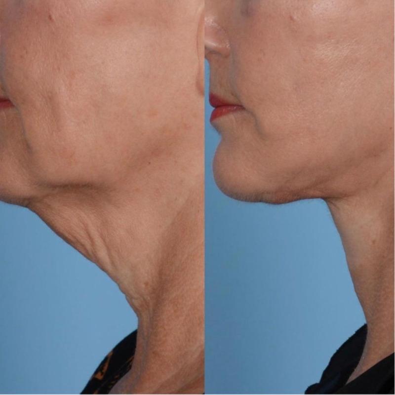 Crema reafirmante para el cuello Samuwac Neck Care Stick, nutritiva, reafirmante y con efecto lifting.