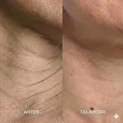 El sistema de microinfusión™