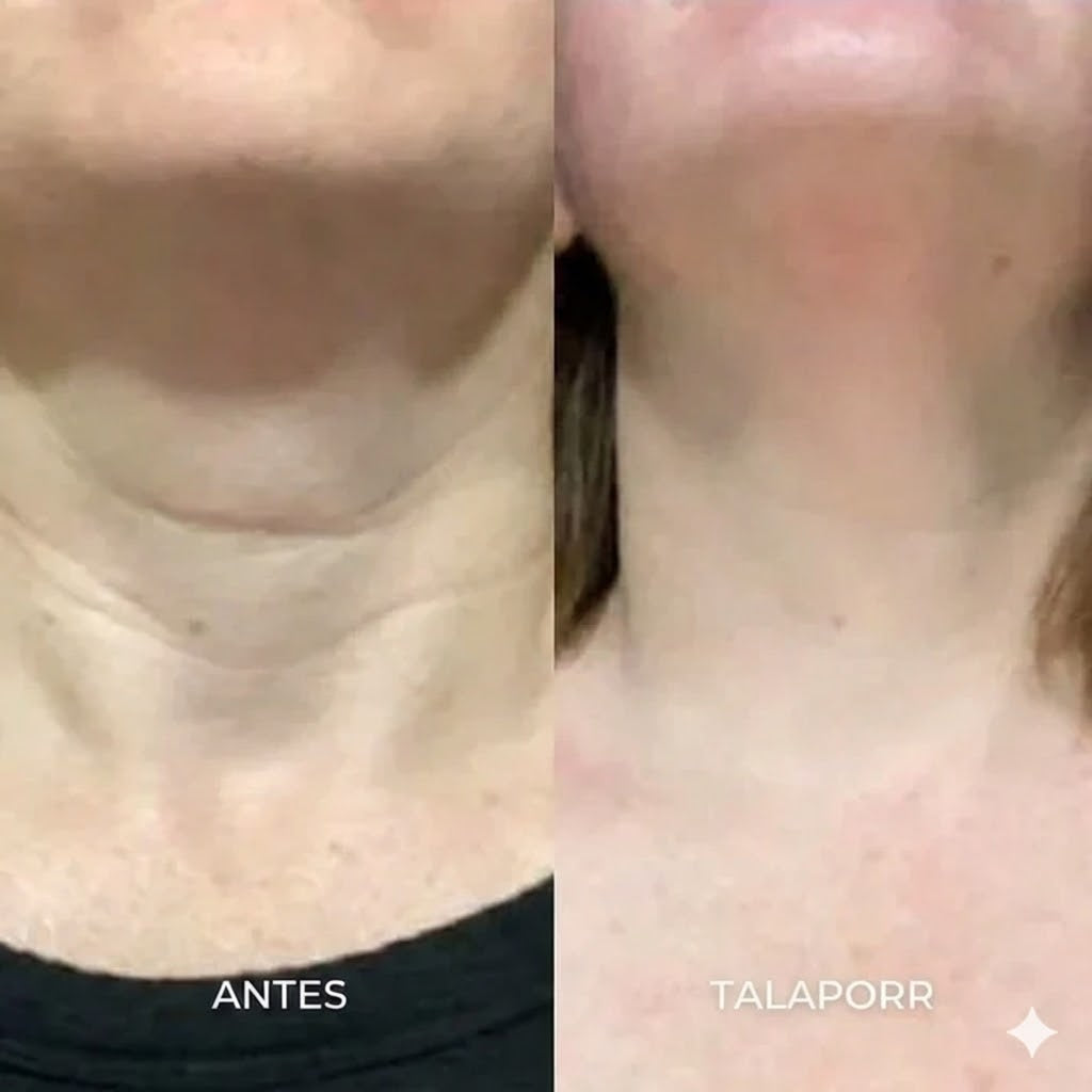 El sistema de microinfusión™