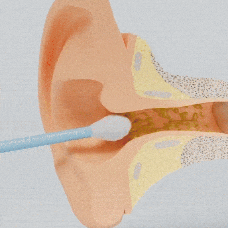 EarView™ – Limpieza inteligente de oídos con tecnología suave y avanzada